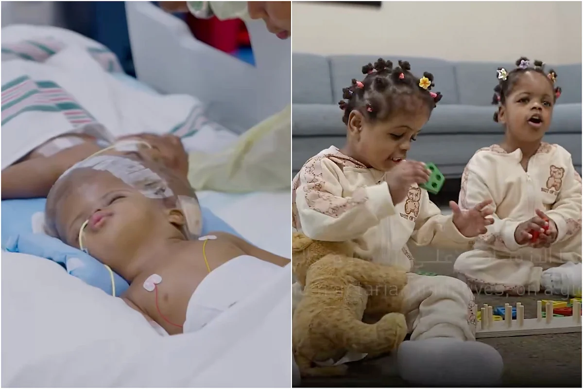 Video: Conjoined twins separated in 4 complex surgeries by A