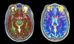 Brain scans show what pain looks like | Khaleej Times