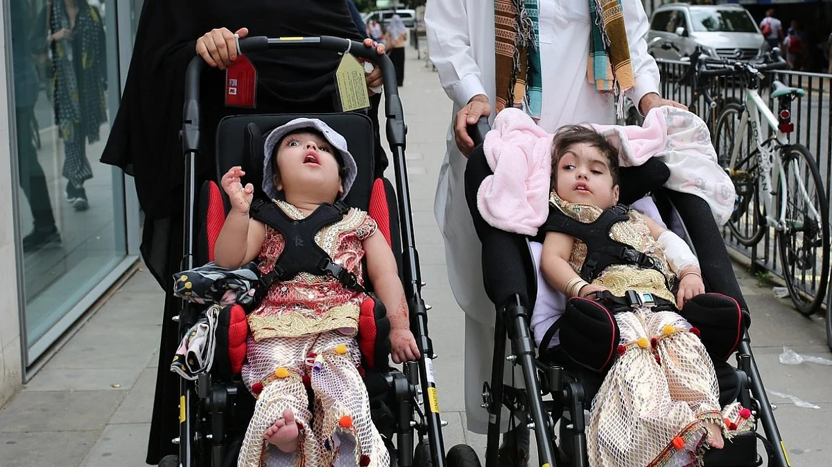 Conjoined Pakistani twins separated in rare surgery in London | Khaleej ...