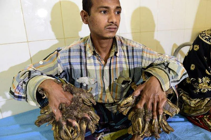 Bangladesh's 'Tree Man' gets skin disease cured | Khaleej Times