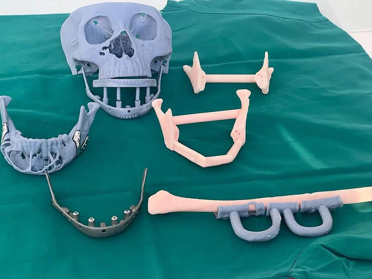 uae-filipina-expat-gets-3d-printed-jaw-after-large-tumour-extracted-in