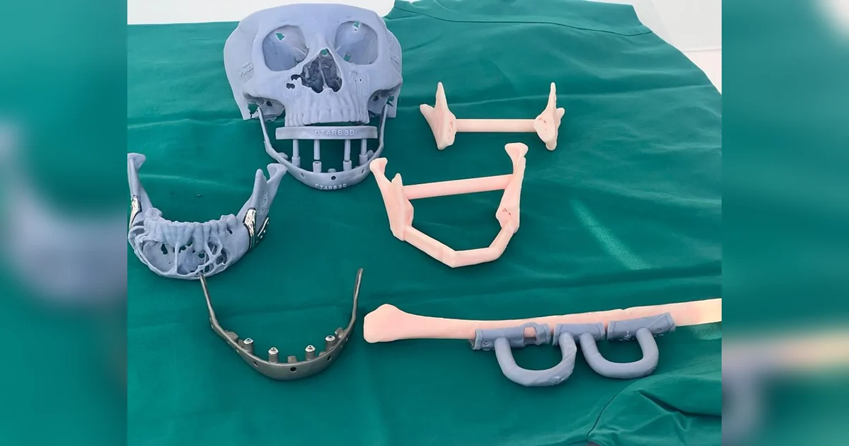 UAE Filipina Expat Gets 3D printed Jaw After Large Tumour Extracted In uae-filipina-expat-gets-3d-printed-jaw-after-large-tumour-extracted-in